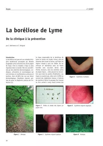 Boreliose de Lyme nahimana F